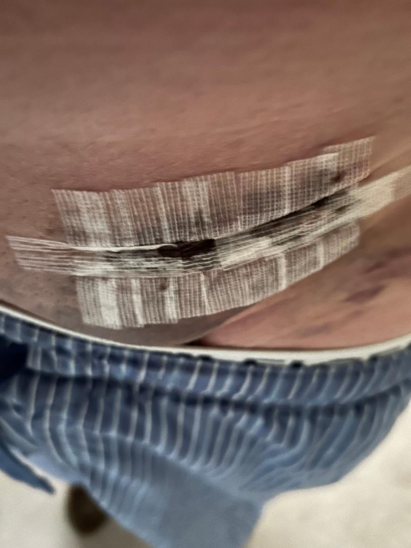 RKS Health: The Great Hernia Adventure: Surgical Options and Preparing ...